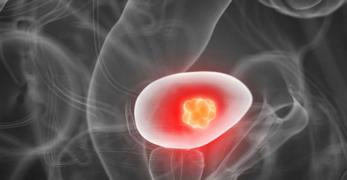 6 Bladder Cancer Symptoms